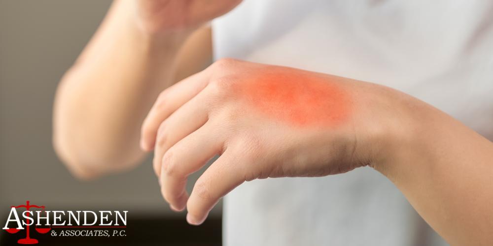 chemical burn accidents