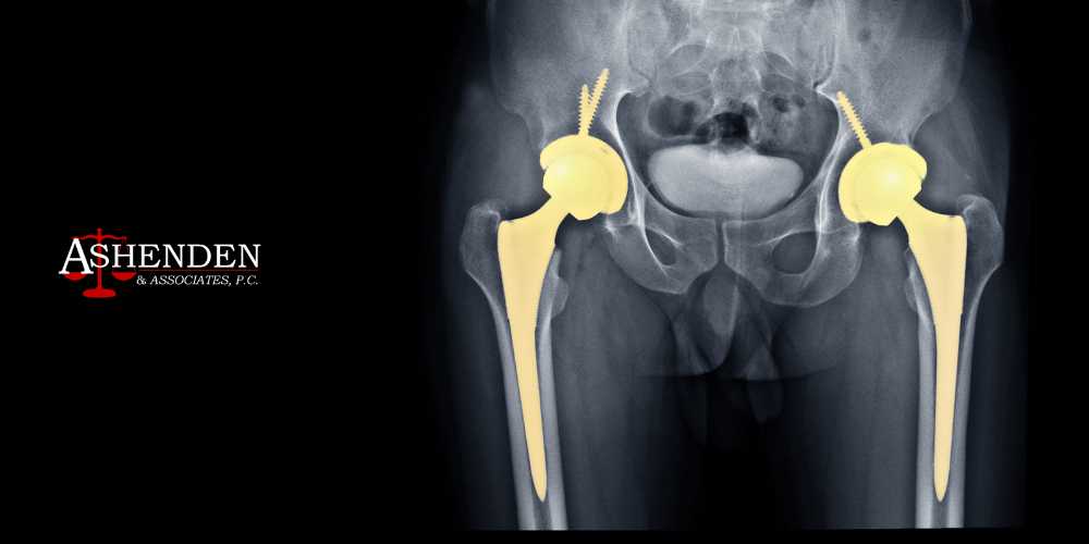 Atlanta Hip Replacement Lawsuit Attorney