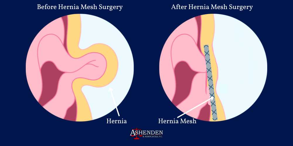 hernia mesh lawsuit sandy springs