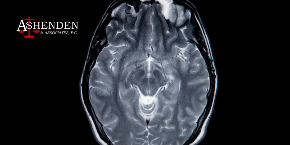 Brain Injury Lawyer Dunwoody