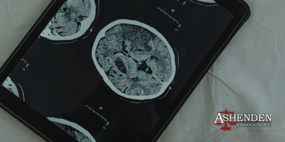 traumatic brain injury lawyer sandy springs